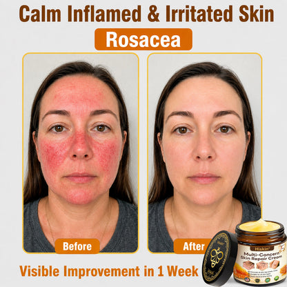 HISKIN® Multi-Concern Skin Repair Cream (One powerful cream to repair inflammation, dryness, aging, pigmentation, and visible skin damage.)