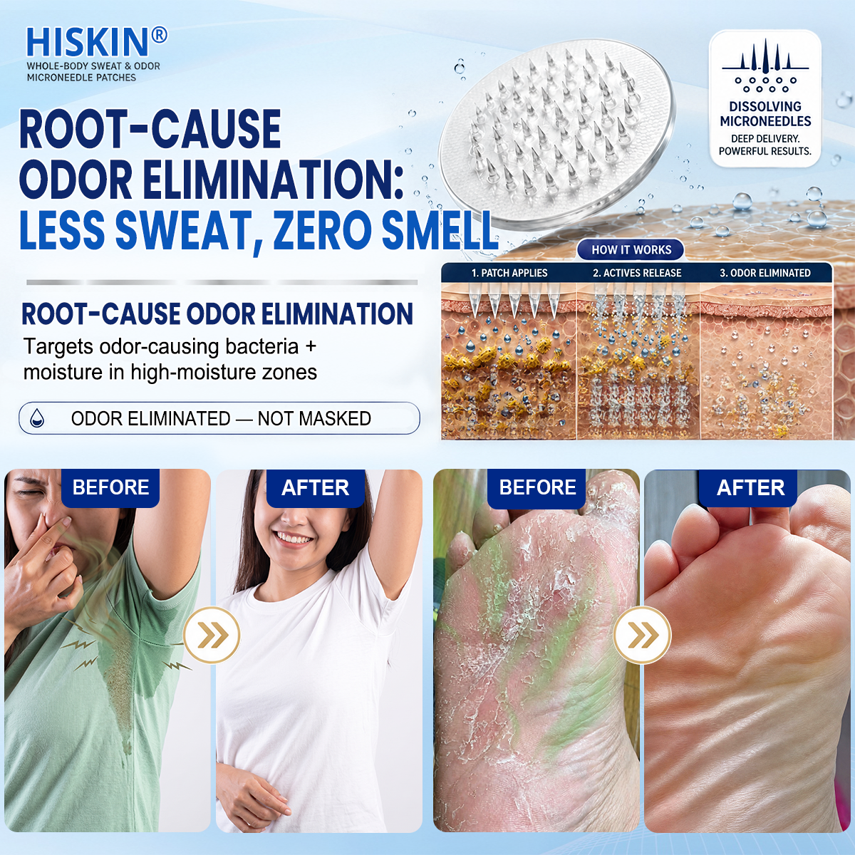 Hiskin® 2-in-1 Advanced Sweat Control & Deodorant Microneedle Patches — For All Genders · Aluminum-Free · Natural Odor Control