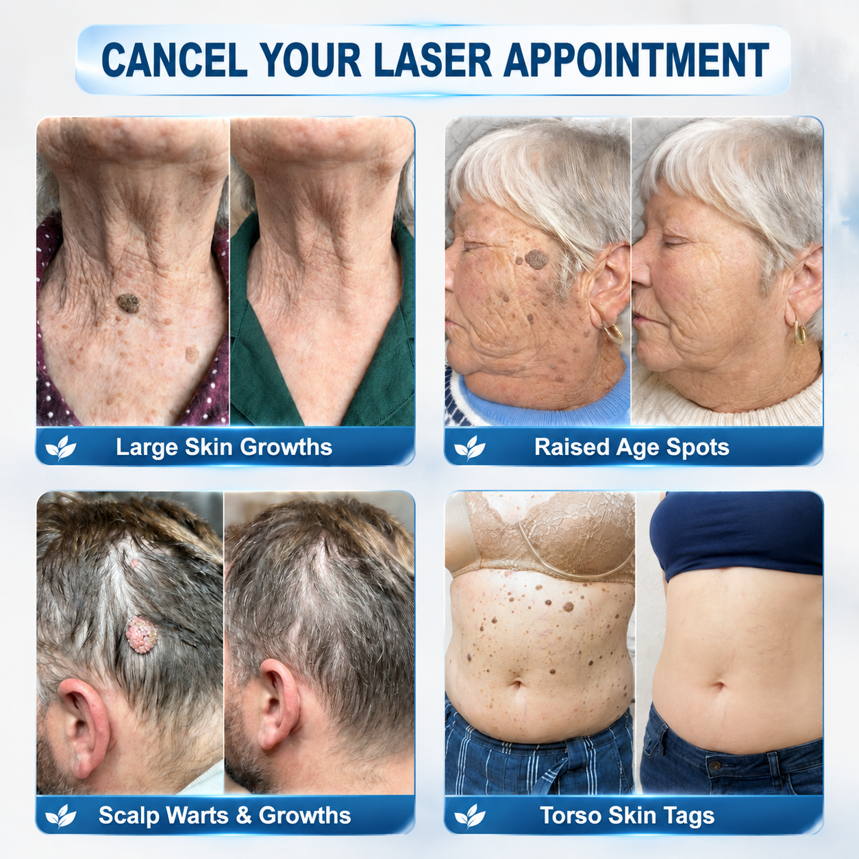 𝐇𝐈𝐒𝐊𝐈𝐍®👩‍⚕️【30%OFF only today】 𝟕-𝐃𝒂𝘆 𝐒𝗸𝐢𝐧 𝐓𝒂𝗴 & 𝐒𝐩𝙤𝐭 𝐄𝐫𝒂𝐬𝙚𝐫 Painless & Scar-Free Advanced Imperfection Removal Rollerball Pen