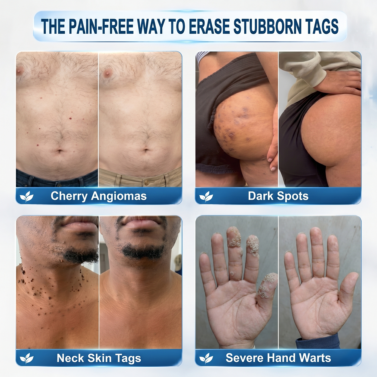 𝐇𝐈𝐒𝐊𝐈𝐍®👩‍⚕️【30%OFF only today】 𝟕-𝐃𝒂𝘆 𝐒𝗸𝐢𝐧 𝐓𝒂𝗴 & 𝐒𝐩𝙤𝐭 𝐄𝐫𝒂𝐬𝙚𝐫 Painless & Scar-Free Advanced Imperfection Removal Rollerball Pen