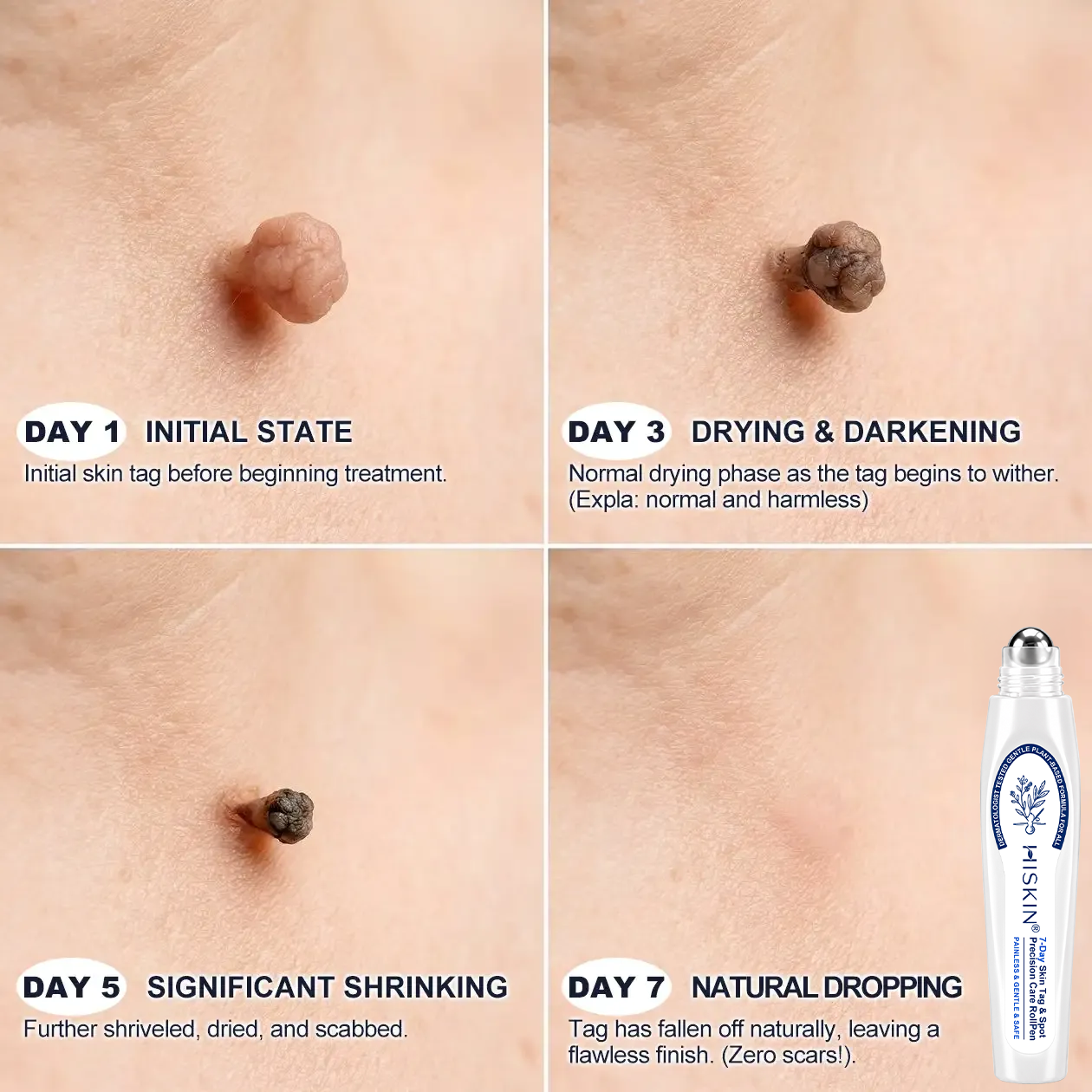 𝐇𝐈𝐒𝐊𝐈𝐍®👩‍⚕️【30%OFF only today】 𝟕-𝐃𝒂𝘆 𝐒𝗸𝐢𝐧 𝐓𝒂𝗴 & 𝐒𝐩𝙤𝐭 𝐄𝐫𝒂𝐬𝙚𝐫 Painless & Scar-Free Advanced Imperfection Removal Rollerball Pen