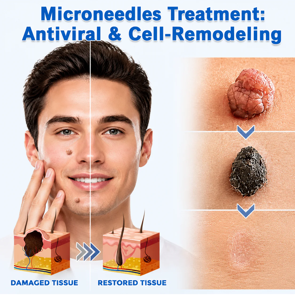 ✨Hiskin ® 2-in-1 Microneedle & Hydrocolloid Patch🍀 | Removes raised moles, acne, flat warts, and skin tags | Helps improve wrinkles, scars, and blemishes | Invisible patches for face and body