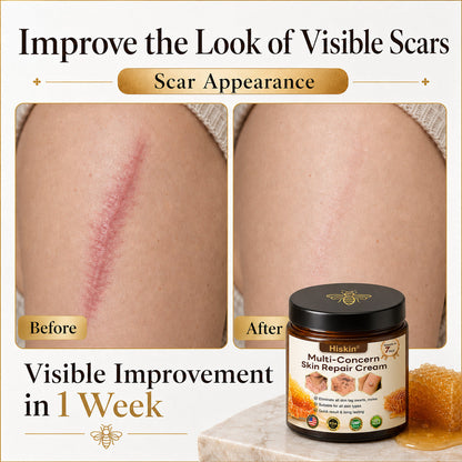 【EXCLUSIVE POST-CARE OFFER】 Target the Spot. Then Help Skin Look Smooth Again. HISKIN® Multi-Concern Skin Repair Cream