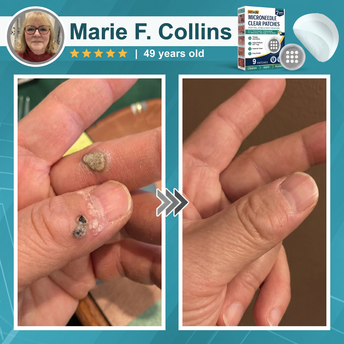 ✨Hiskin ® 2-in-1 Microneedle & Hydrocolloid Patch🍀 | Removes raised moles, acne, flat warts, and skin tags | Helps improve wrinkles, scars, and blemishes | Invisible patches for face and body