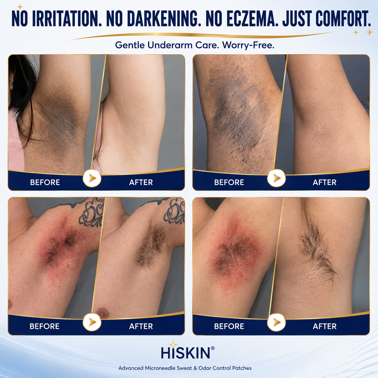 Hiskin® 2-in-1 Advanced Sweat Control & Deodorant Microneedle Patches — For All Genders · Aluminum-Free · Natural Odor Control