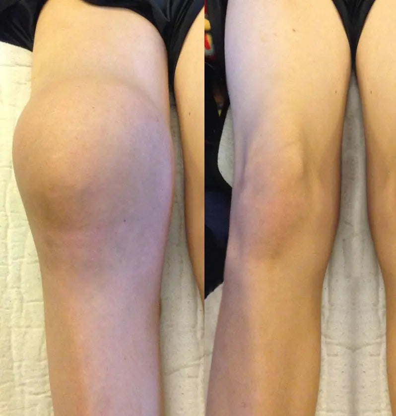 Knee swelling comparison