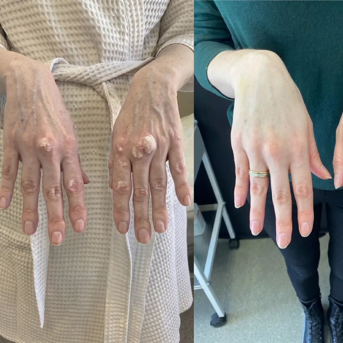 Hand joint comparison