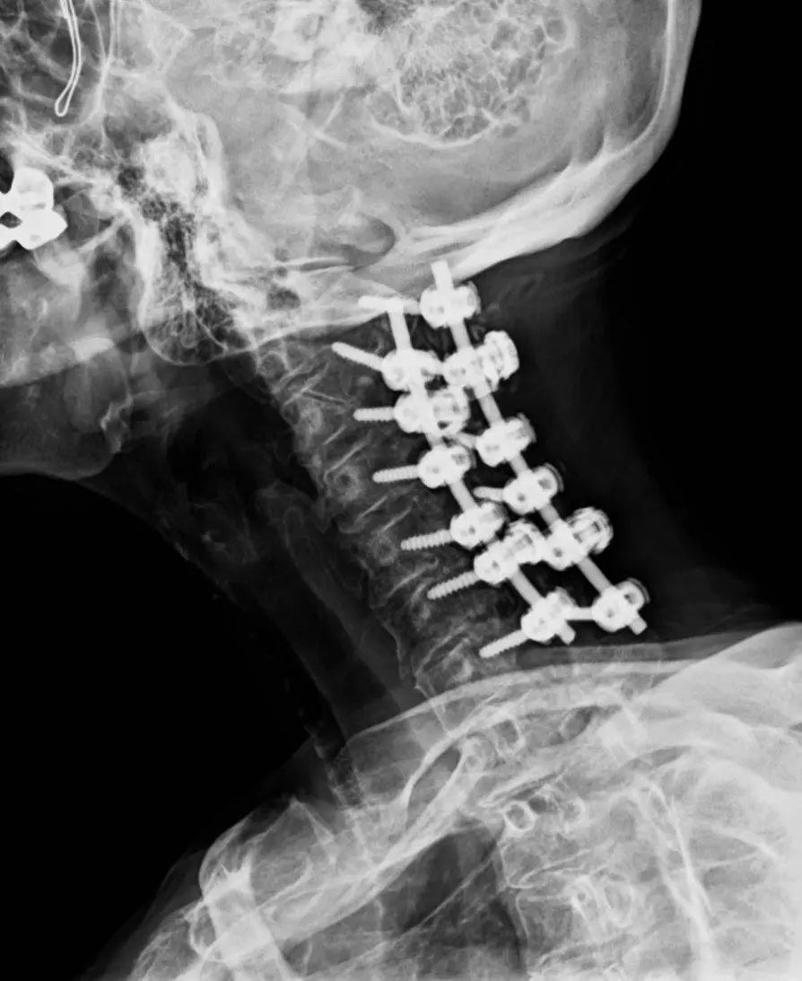 Post-surgery cervical X-ray