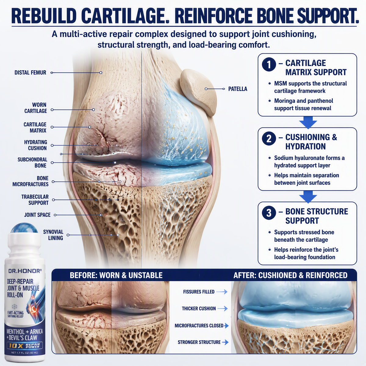 Cartilage rebuilding and bone support mechanism
