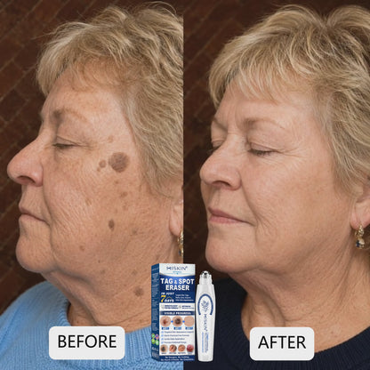 𝐇𝐈𝐒𝐊𝐈𝐍®👩‍⚕️ 𝟕-𝐃𝒂𝘆 𝐒𝗸𝐢𝐧 𝐓𝒂𝗴 & 𝐒𝐩𝙤𝐭 𝐄𝐫𝒂𝐬𝙚𝐫 Painless & Scar-Free Advanced Imperfection Removal Rollerball Pen