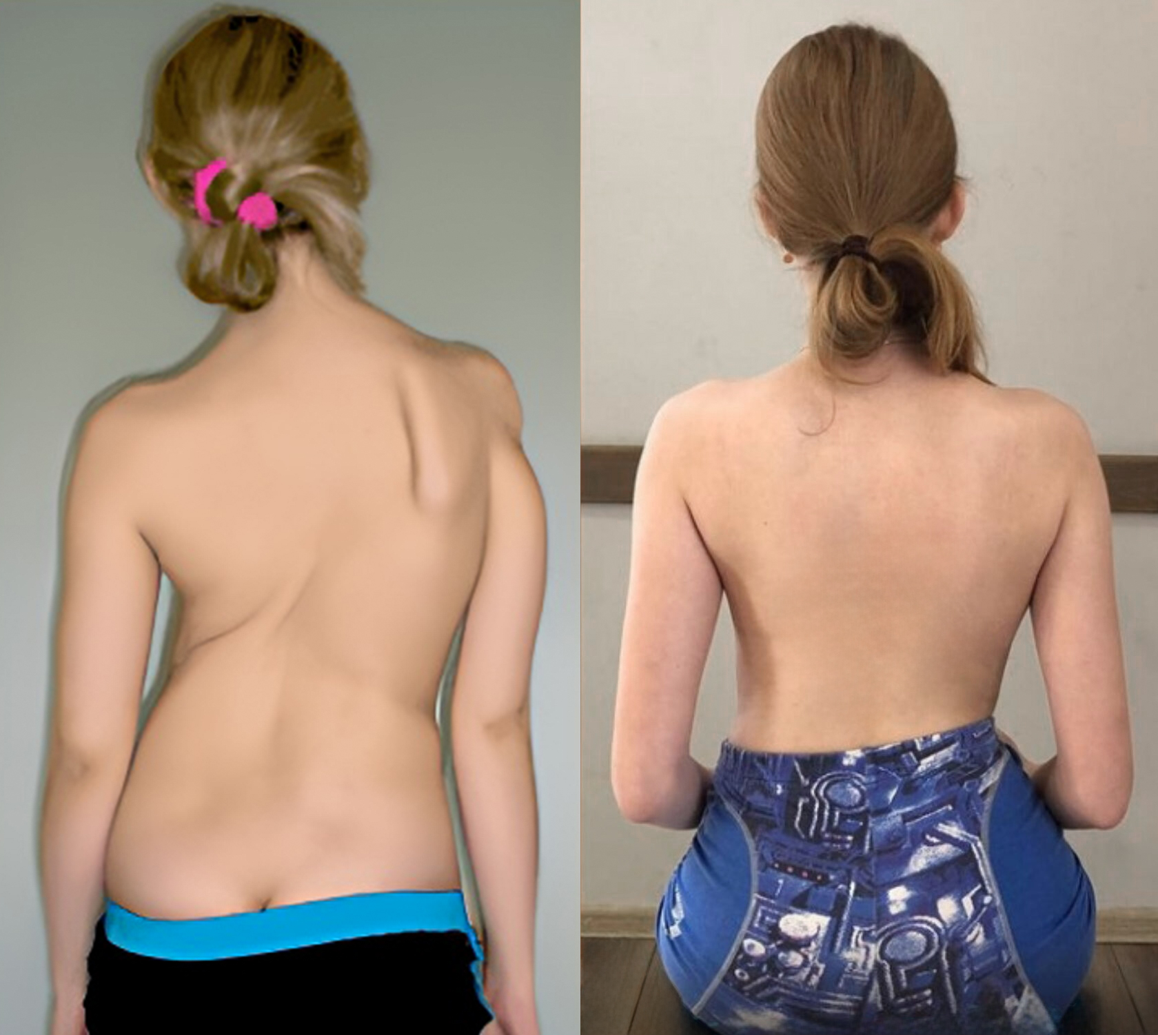 Back posture before and after comparison