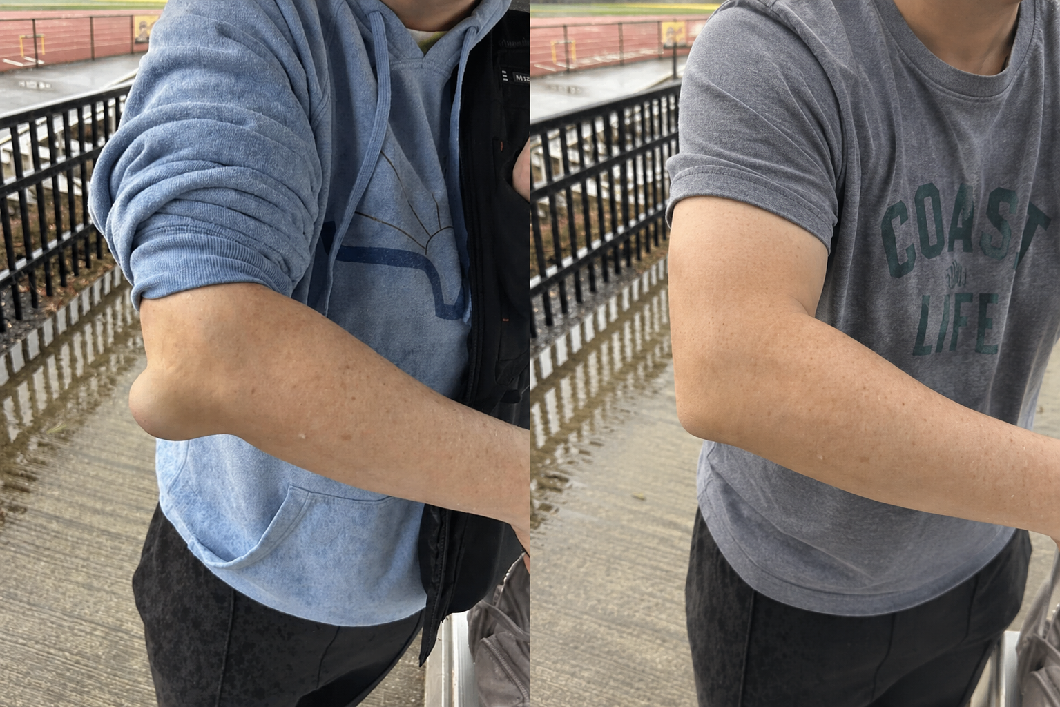 Elbow swelling before and after comparison