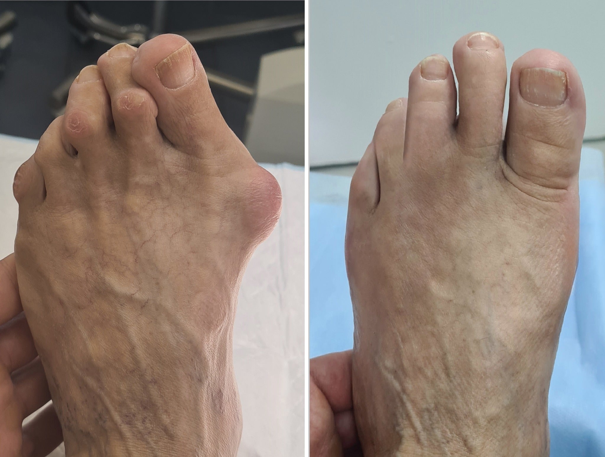 Bunion discomfort before and after comparison