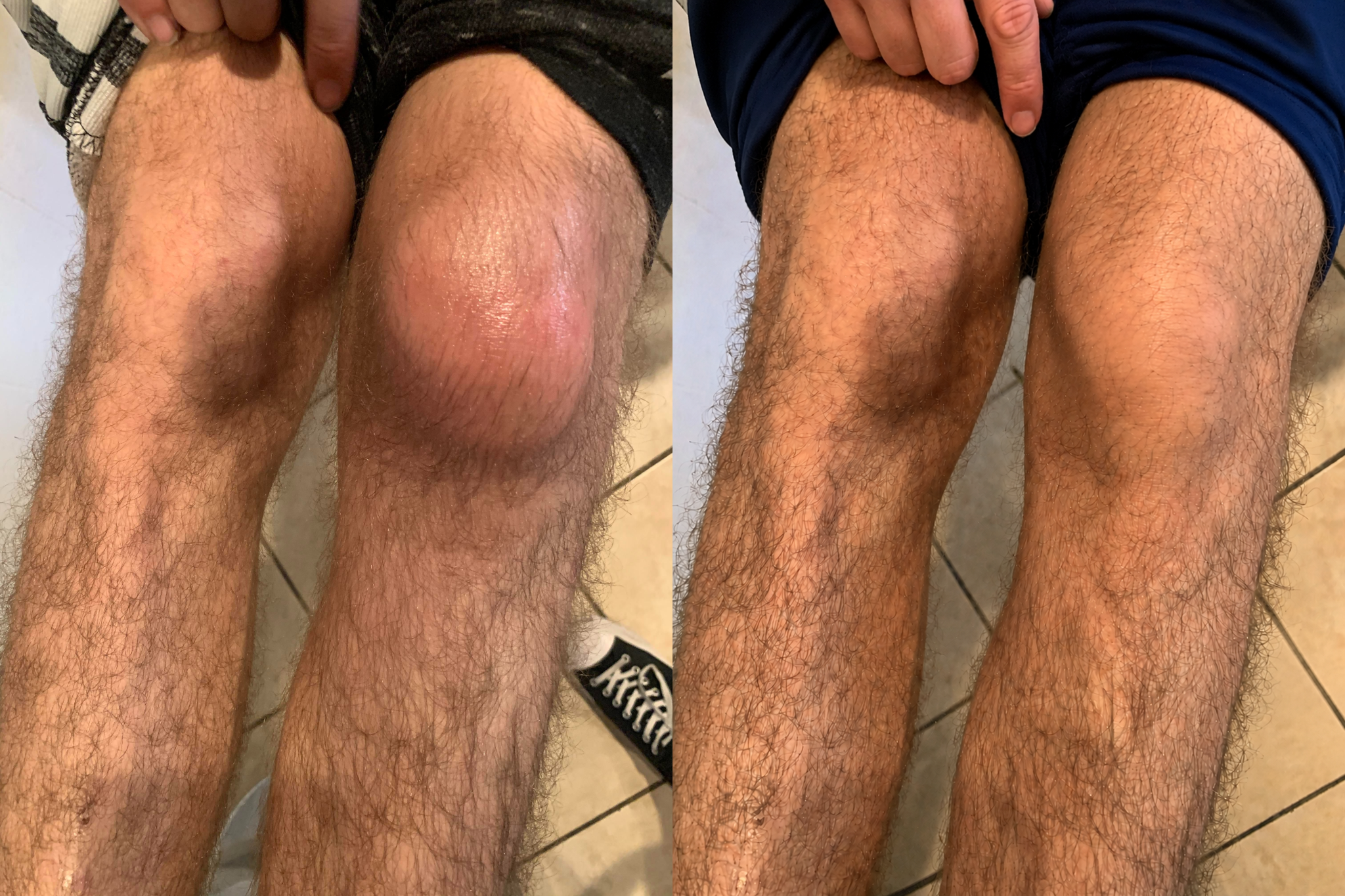 Knee swelling before and after comparison